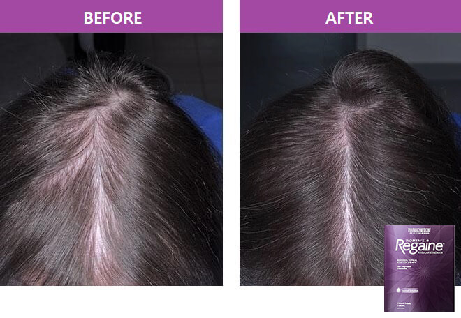 REGAINE Women's Regular Strength Hair Regrowth Treatment